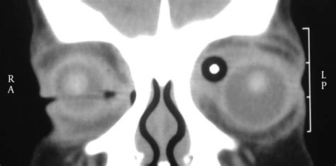 Coronal View of the Orbital CT-Scan | Download Scientific Diagram