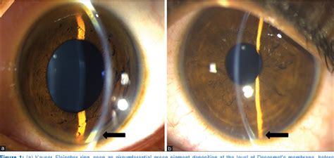 Kayser Fleischer Rings Slit Lamp