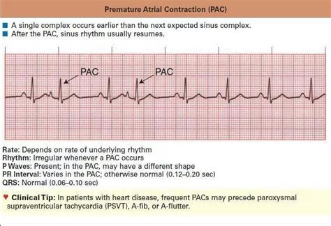 Pin by Carmen Witczak on Ekg | Medical mnemonics, Normal sinus rhythm, Paramedic school