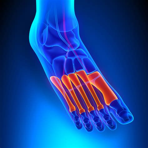 Metatarsalgia: What It Is and How It’s Treated - Foot Pain Treatment