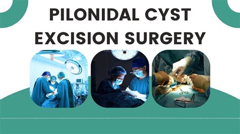 Know about pilonidal cyst excision surgery and incision surgery