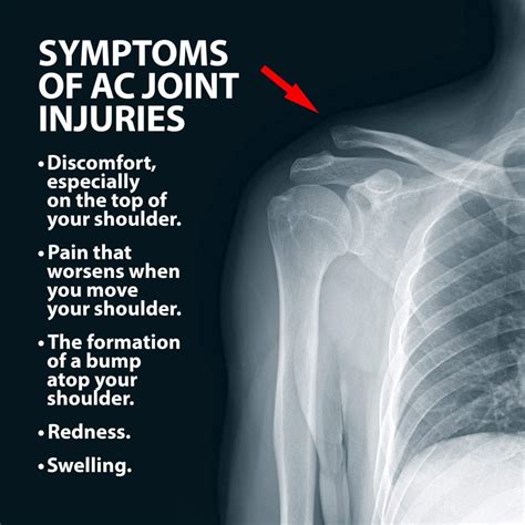 AC Joint Injuries | Florida Orthopaedic Institute