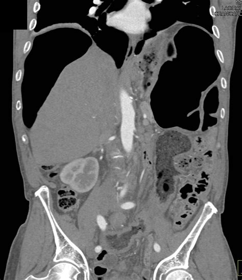 Sigmoid Volvulus - Colon Case Studies - CTisus CT Scanning