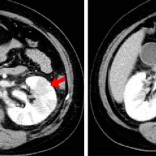 Abdominal CT scan showing renal enlargement, thickening of Gerota's ...