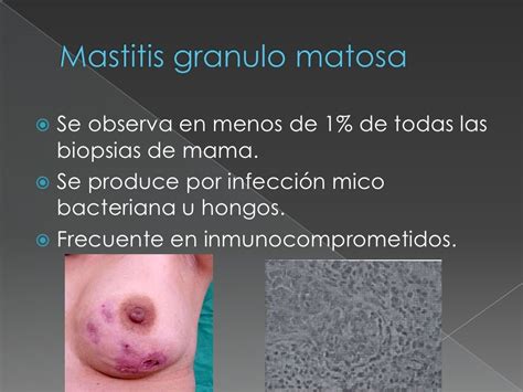 Mastitis