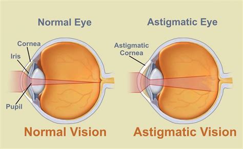 Šta je to astigmatizam? - Medikal Optik