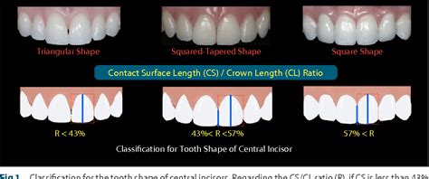 Figure 1 from Significance of crown shape in the replacement of a central incisor with a single ...