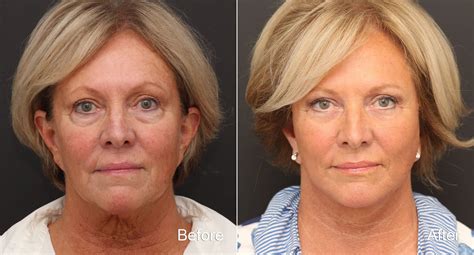 Facelift Photos | Princeton, NJ | Patient 9080