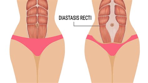 Diastasis recti in pregnancy causes, signs, symptoms, treatment & exercises