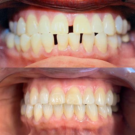 Invisalign Before And After | Firouz Orthodontics - West Los Angeles