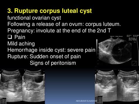 Corpus Luteum Cyst Rupture During Early Pregnancy - PregnancyWalls