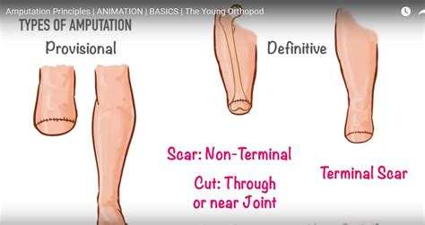 Principles of Amputation Surgery — OrthopaedicPrinciples.com