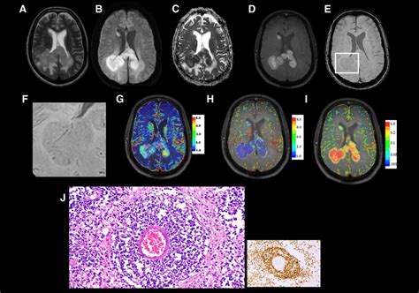 Typical PCNSL: 66-year-old female patient presented with memory loss... | Download Scientific ...