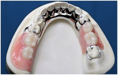 Partial dentures: What are advantages and disadvantages? – Tehran ...