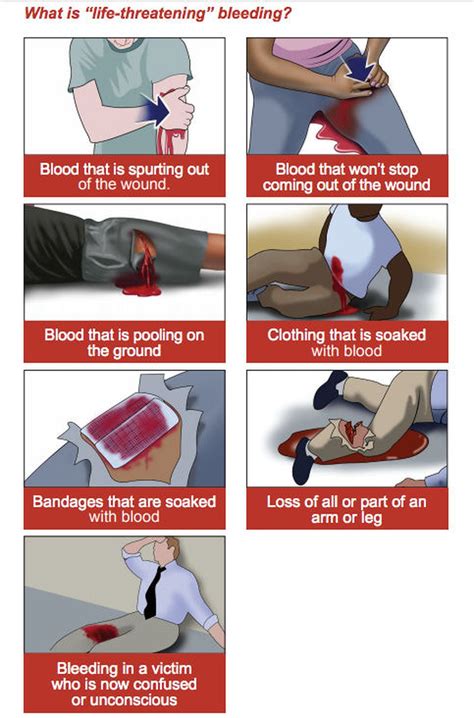 Formidable Tips About How To Stop Bleeding In Hand - Horsebud99