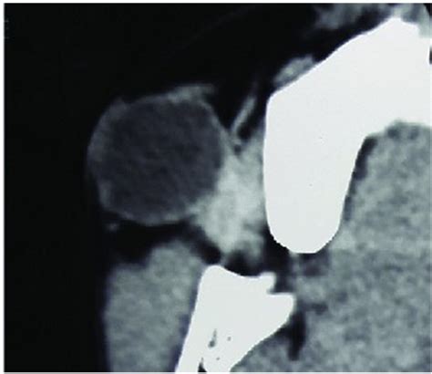 CT scan of right cheek showing well defined hypodense lesion. | Download Scientific Diagram