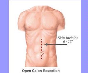 Enhanced Recovery After Surgery | Colorectal Surgery