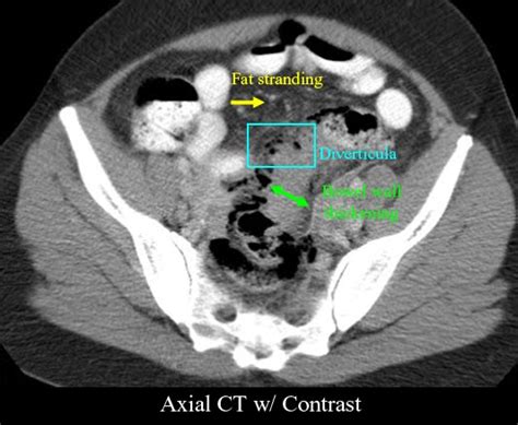 RadiologySpirit: Diverticulitis of the Sigmoid Colon with Fat Stranding on CT Scan