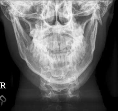 Mandibular Fracture X Ray