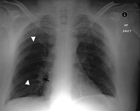 Westermark’s and Palla’s Signs in Acute Pulmonary Embolism | Circulation