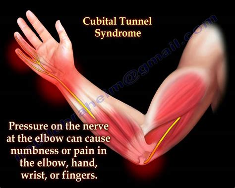 Ulnar nerve entrapment