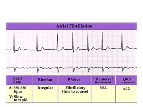 Mitral stenosis