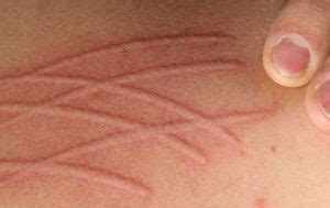 Dermatographic Urticaria - Causes, Symptoms, Treatment and Prevention