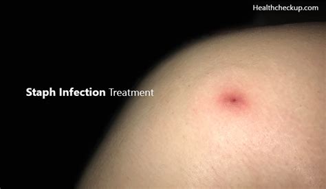 Staph Infection Treatment | Symptoms of Staph Infection | Health Checkup