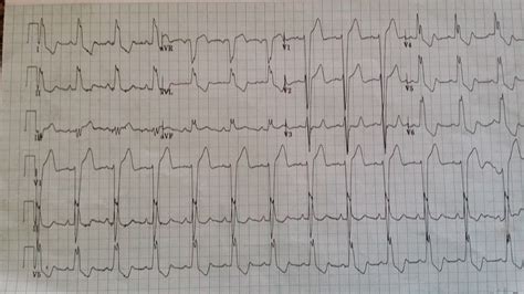 modified Sgarbossa criteria for diagnosing STEMI (?case for STEMI ...