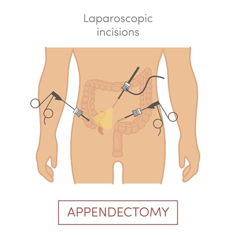 APENDICITIS - Mind Map