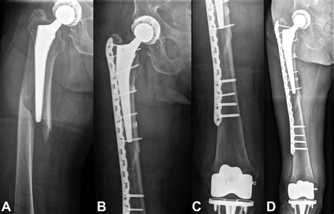 Periprosthetic Femur Fractures Orthopaedicprinciples | The Best Porn Website