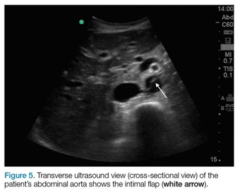 Identification of Aortic Dissection Using Limited Bedside Ultrasound ...