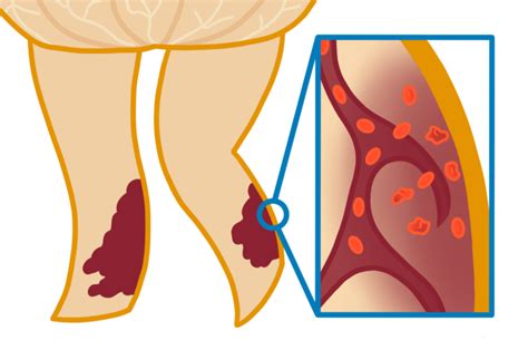 Hemosiderin Staining - Why Your Legs Are Turning Brown - Delaware Vein Center