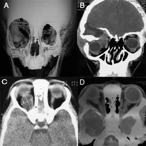 Best CT Orbit Scan Centre in Pune | Surya Diagnostic