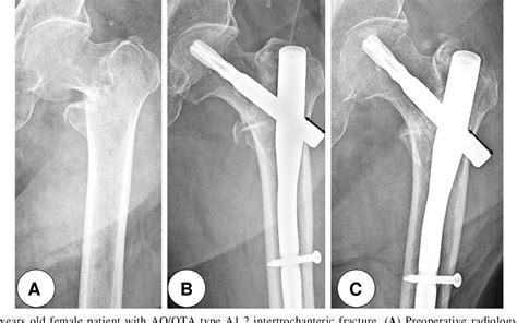 Figure 2 from PFNA and PFN in Intertrochanteric Fractures - Comparison ...