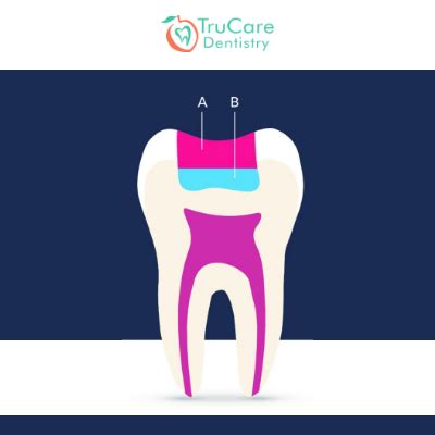 Indirect Pulp Capping 101: Know About the Procedure, Materials, Benefits, and Risks