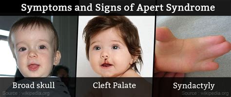 Apert Syndrome - Causes, Symptoms, Diagnosis & Treatment