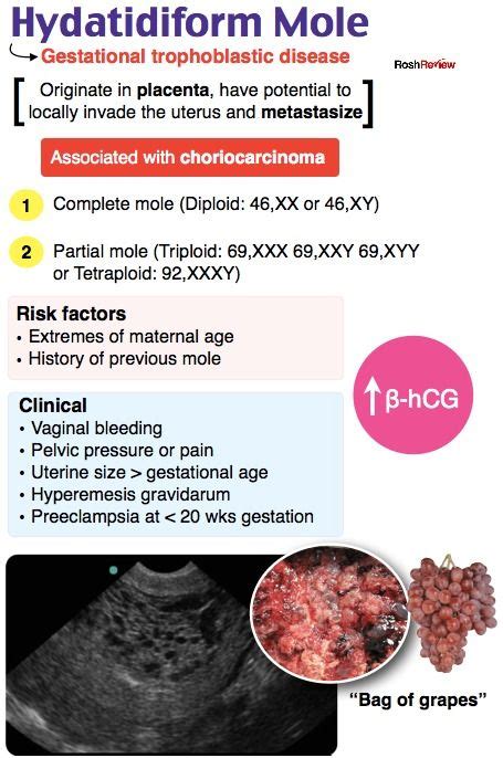 Hydatidiform Mole | Medical ultrasound, Medical school advice, Prenatal ...