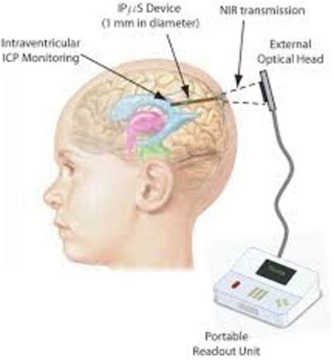 Worldwide Intracranial Pressure (ICP) Monitoring Devices Market and ...