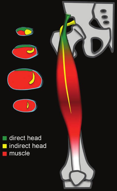 Rectus Femoris Muscle Mri Anatomy