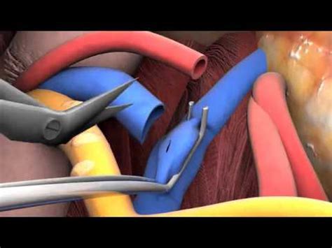 Lecture 2-6: Kidney transplant surgery - YouTube