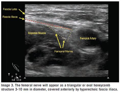 The Femoral Nerve Block — EM Curious