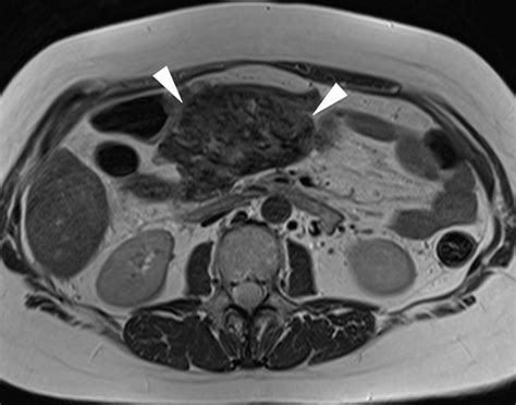 Imaging Assessment of Etiology and Severity of Acute Pancreatitis | Pancreapedia