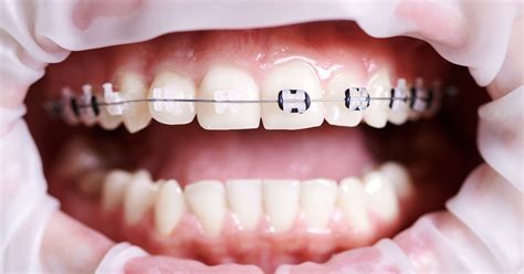 Sapphire braces: what they are, price, pros and con 🦷