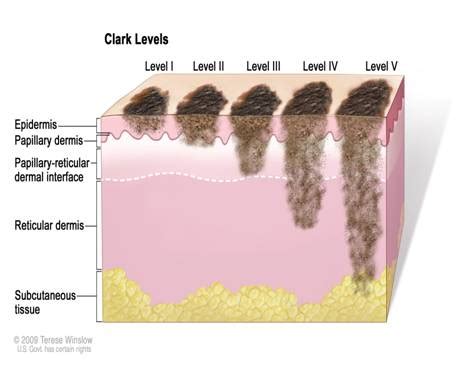 Melanoma: Classificazione di Clark e Stadiazione