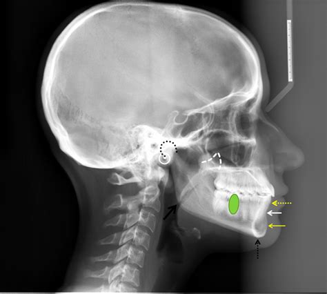 coronoid process – Dr. G's Toothpix