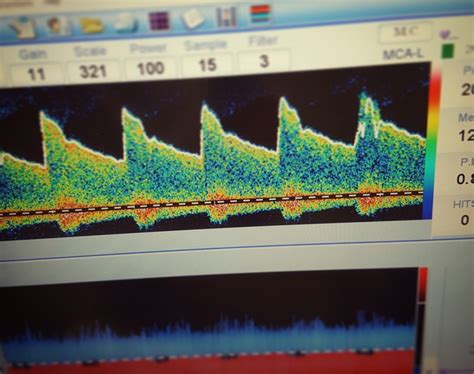 Transcranial Doppler (TCD) Ultrasound