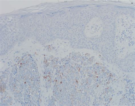 Pathology Outlines - Merkel cell carcinoma