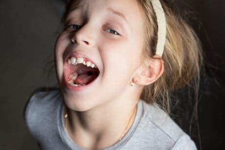 Cuando los dientes de leche no se caen - Criar con Sentido Común