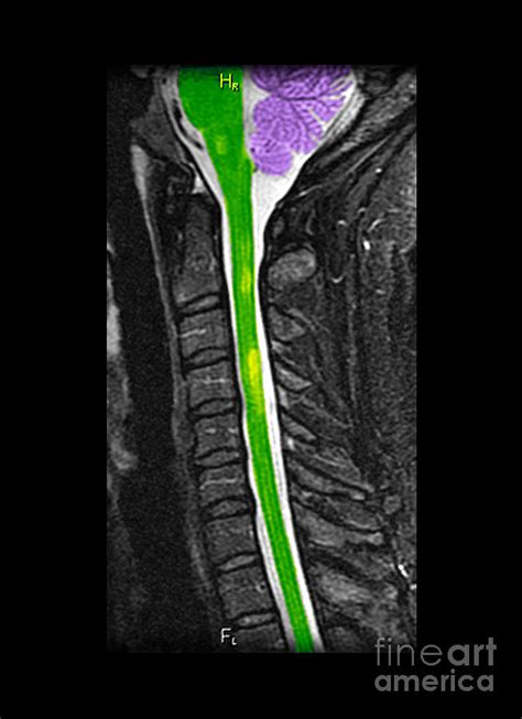 Multiple Sclerosis In Spinal Cord Photograph by Living Art Enterprises - Pixels